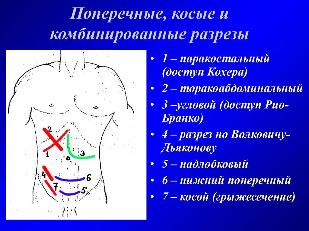 Какое лапаротомия. Схема оперативных доступов к органам брюшной полости. Оперативные доступы к органам верхнего отдела брюшной полости. Доступы к верхнему этажу брюшной полости. Доступы в брюшную полость.