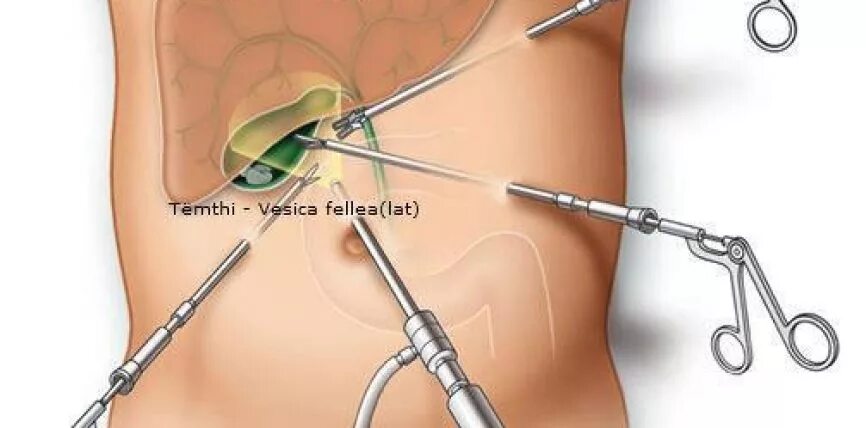 После удаления желчного пузыря. Холецистит и лапароскопическая холецистэктомия. Лапаротомия лапароскопия холецистэктомия. Острый холецистит лапароскопия. Лапароскопия холецистит.
