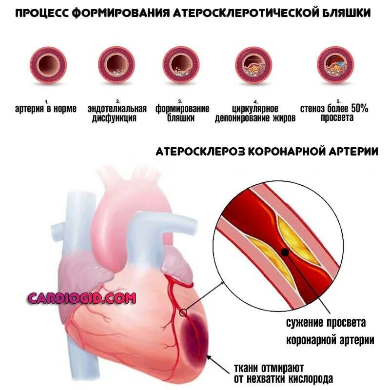 Диффузные сосуды. Ишемическая болезнь сердца стадия 5 степени. Степени атеросклероза венечных артерий. Атеросклероз ИБС стенокардия инфаркт. Атеросклероз коронарных сосудов симптомы.