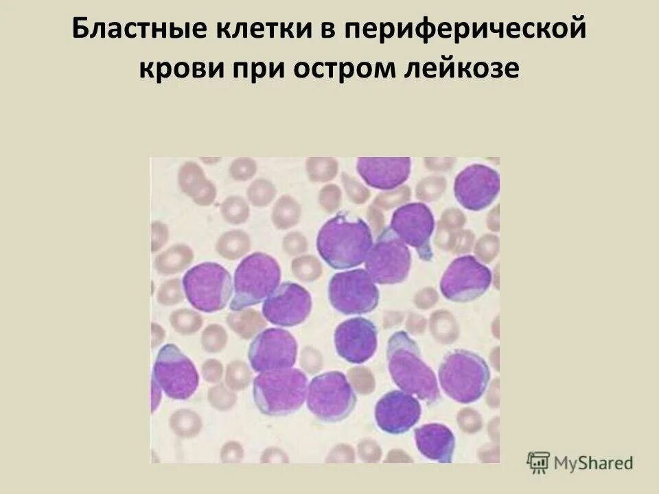 Бластные клетки в крови при остром лейкозе. Лимфоциты бластные клетки. Бласты в периферической крови при лейкозе. Бластные клетки в крови микроскопия.