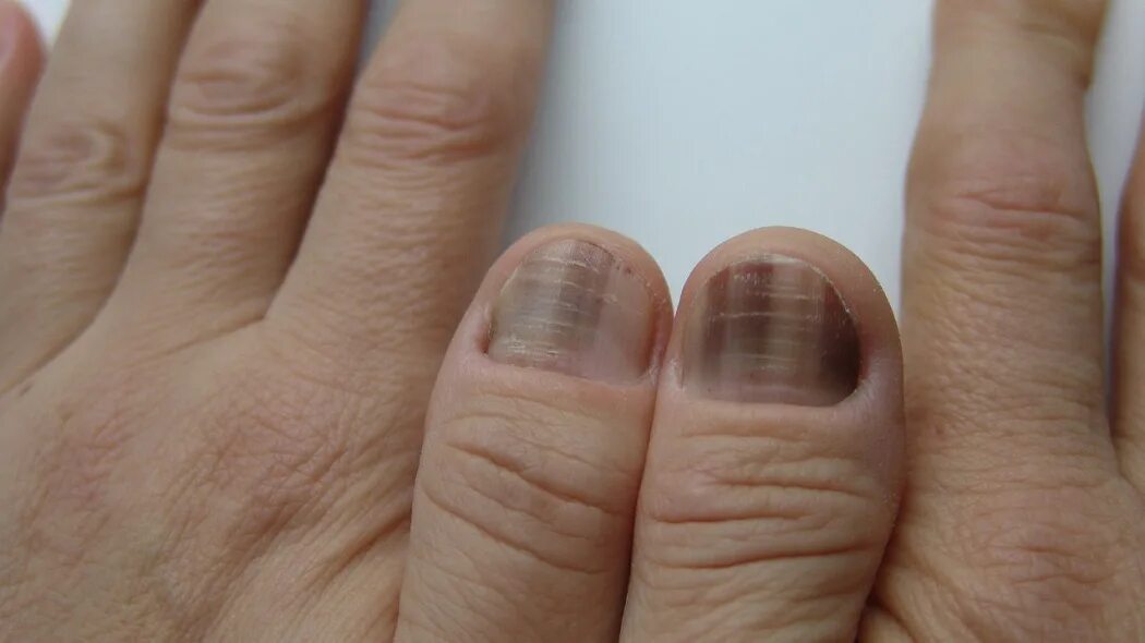 От чего синеют ногти