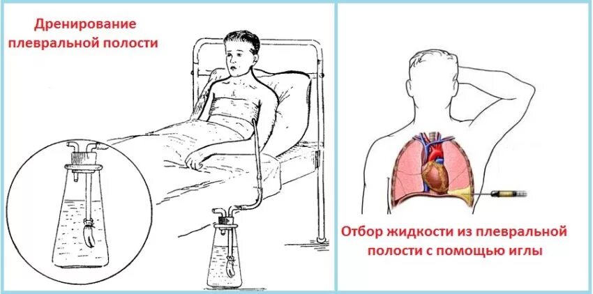 дренирование легкого. дренирование плевральной полости при абсцессе легкого. дренирование легкого. дренирование плевральной полости при пневмотораксе. дренирование плевральной полости при пневмотораксе инструменты.