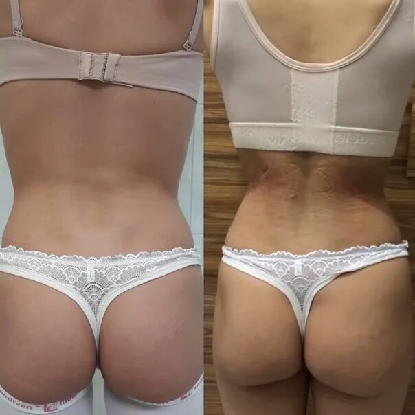 Сужение талии по методу доктора кудзаева. Формирование узкой талии. Операция сужение талии кудзаева. Талия по методу кудзаева. Ребра кудзаева.