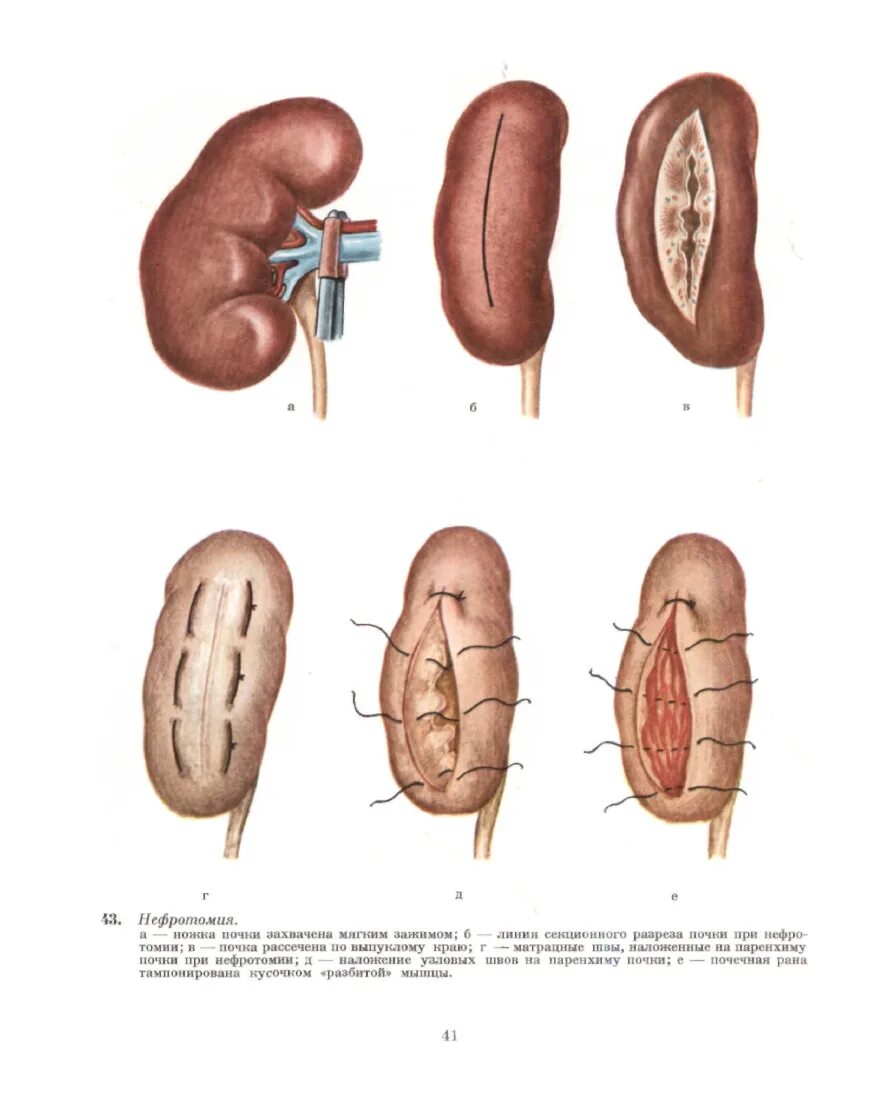 Оперативная хирургия почек нефротомия. Нефротомия. Нефротомия. Нефротомия техника операции. Техника выполнения нефротомии.