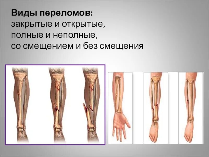 Причины переломов костей конечностей. Переломы костей закрытый открытый. типы переломов костей конечностей.