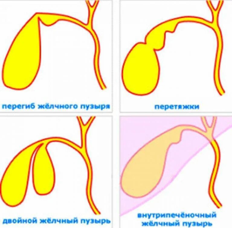 Что будет если удалить желчный пузырь. Аномалия формы желчного пузыря у ребенка Перегиб. Деформация желчного пузыря перегибом. Двойной Перегиб желчного пузыря. Желчный пузырь грушевидной формы с перегибом в шейке.