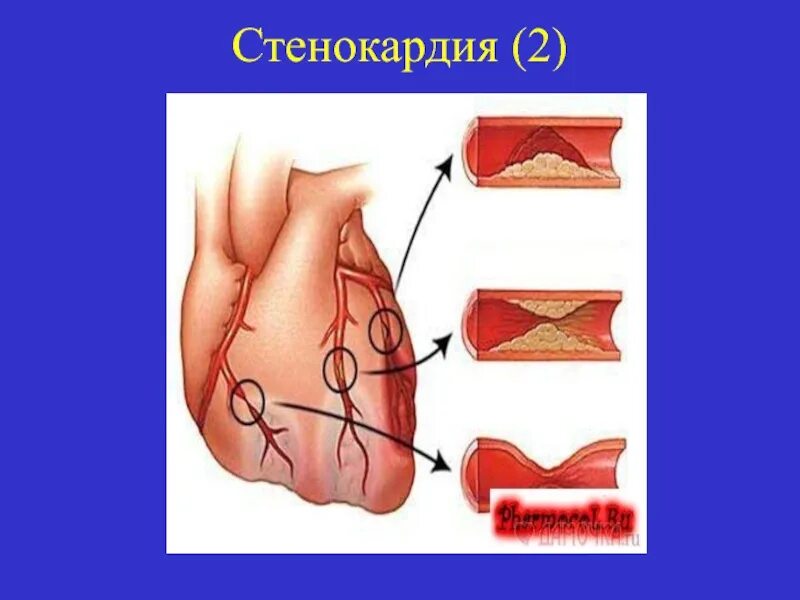 Рефлекторные синдромы остеохондроза. Стеноз коронарных артерий симптомы. Данные анамнеза при приступе стенокардии. Тахикардия противопоказания. Рефлекторная стенокардия.