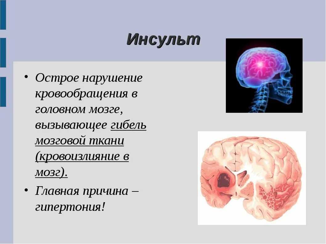 Острое нарушение кровообращения головного мозга. Кровоизлияние в головной мозг. Инсульт. Презентация на тему инсульт.