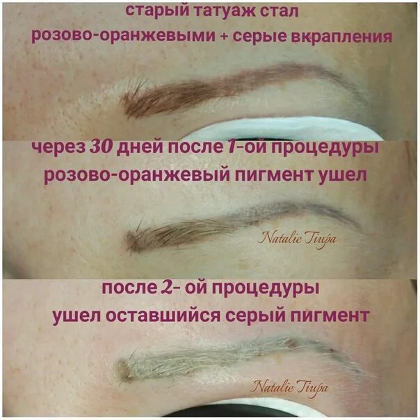 Ревайвинг для удаления татуажа Фото работ по удалению перманентного макияжа и татуировок: удаление татуажа рему