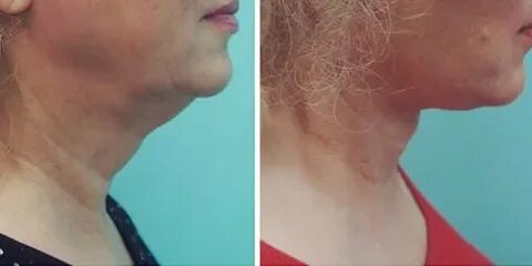 Индюшачья шея у женщин