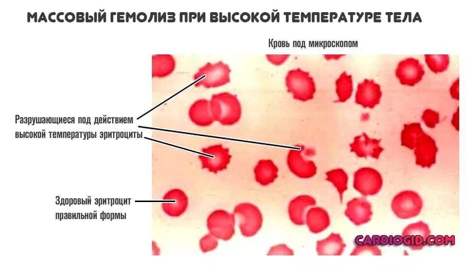 Гемолиз эритроцитов в крови. Процесс гемолиза эритроцитов. Механизмы внутрисосудистого гемолиза эритроцитов. Гемолиз – внутрисосудистое разрушение эритроцитов..