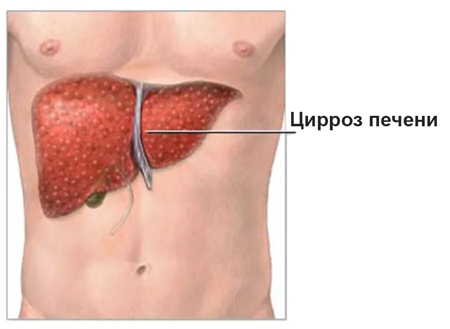 Заболевание печен. Печеночные проявления цирроза печени. Печень больного циррозом печени. Цирроз печени симптомы болезни.