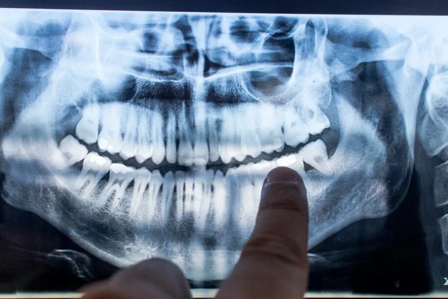 Снимок зубов видное. Рентген всей полости. Рентген зубов красочные.