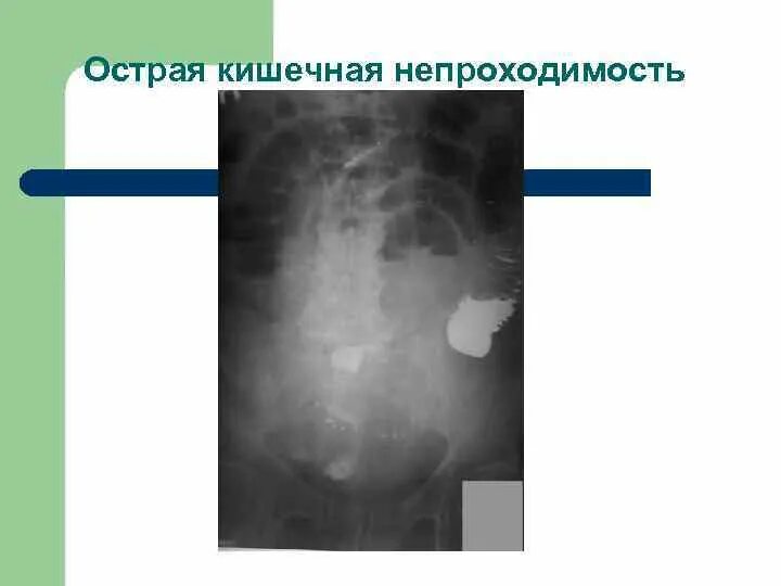 Непроходимость кишечника при онкологии. Острая кишечная непроходимость лекция. осложнения острой кишечной непроходимости. перитонить с явлениями кишечной непроходимости.