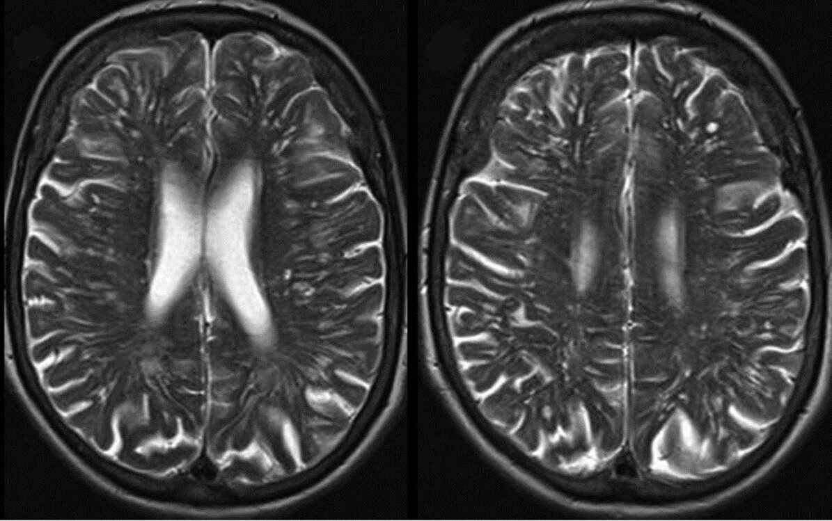 Мелкие очаги в головном мозге. Расширение периваскулярных пространств Вирхова-Робина мрт. Расширение периваскулярных пространств мрт. Расширение пространств Вирхова-Робина. Расширение пространств Вирхова-Робина кт.