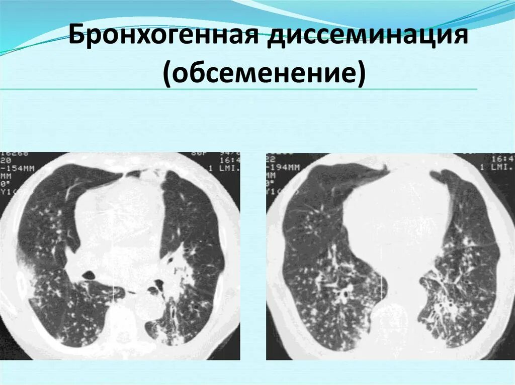 Диссеминированный туберкулез фаза инфильтрации. Подострый диссеминированный туберкулез рентген. очаги бронхогенной диссеминации. гематогенный туберкулез кт. бронхогенная диссеминация при туберкулезе на кт.