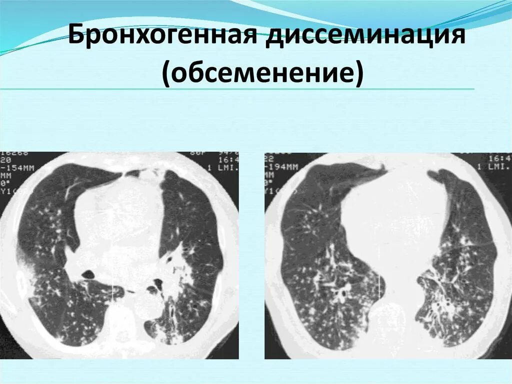 Диссеминированный туберкулез фаза инфильтрации. Подострый диссеминированный туберкулез рентген. Очаги бронхогенной диссеминации. Гематогенный туберкулез кт. Бронхогенная диссеминация при туберкулезе на кт.