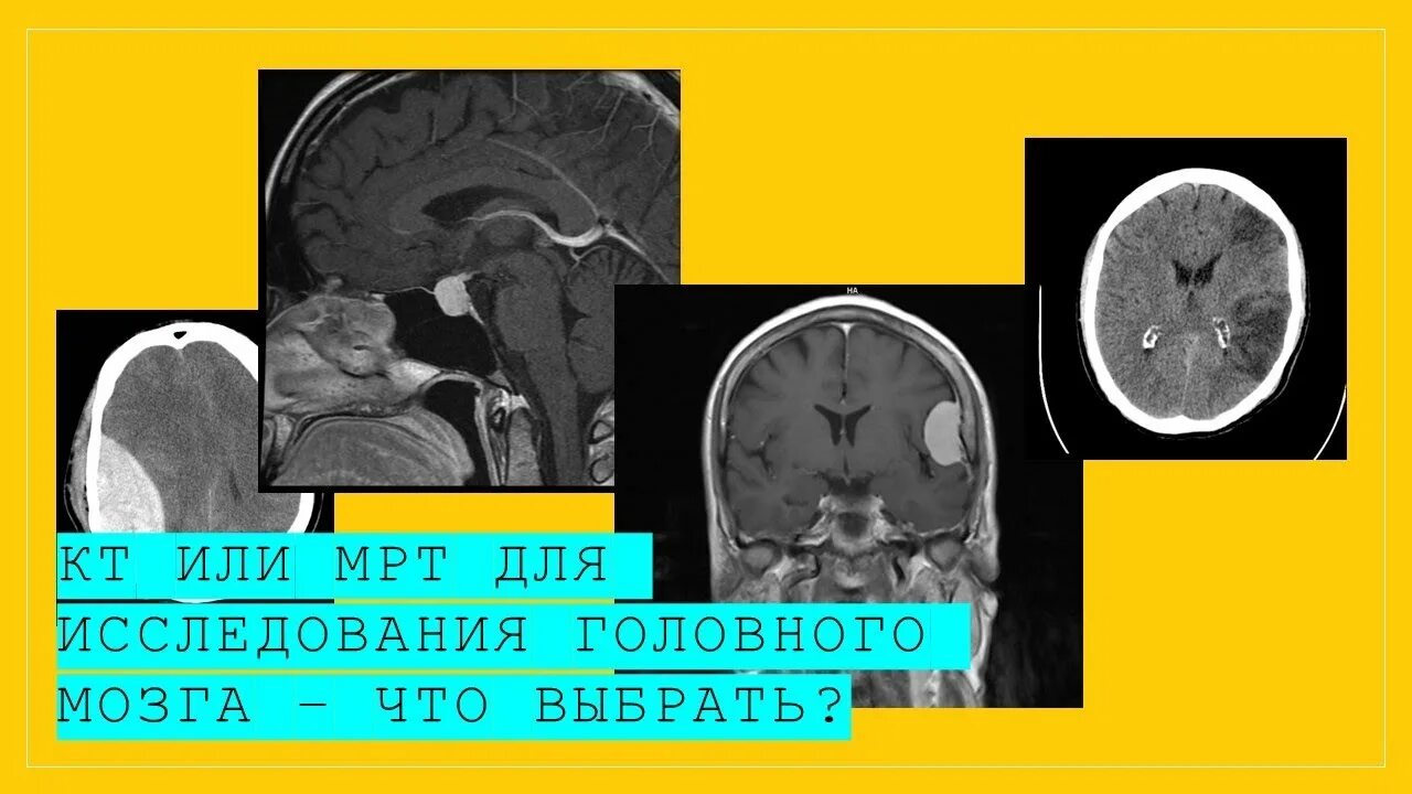 Исследование головного мозга. Мрт мозга. Кт или мрт. Магнитно-резонансные исследования головы.