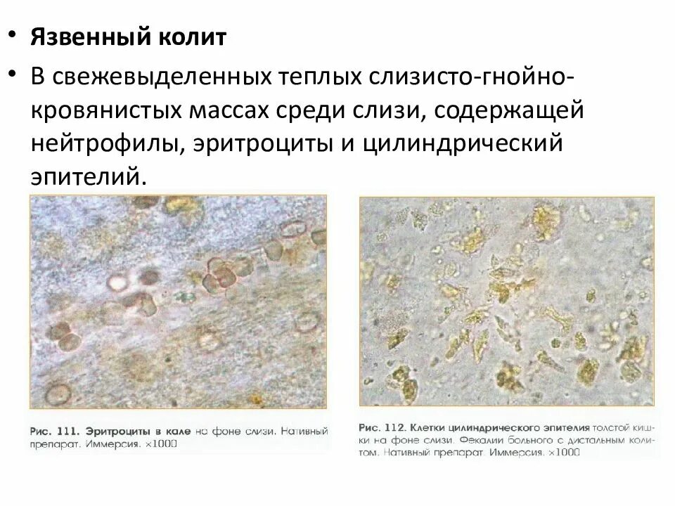 Эритроциты в кале у взрослого. Эритроциты в кале у взрослого