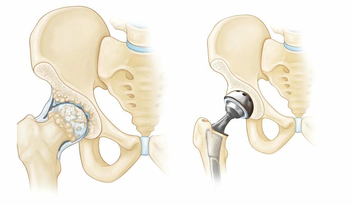 Эндопротезирование тазобедренного сустава. Implantcast тазобедренный сустав. Гемипротез тазобедренного сустава. Артропластика тазобедренного сустава. Как происходит операция по замене тазобедренного сустава