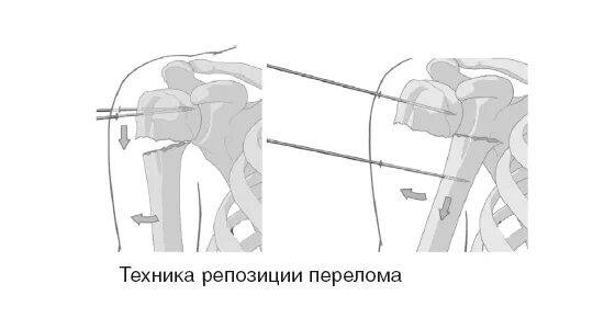 Репозиция костей бедра. Сгибание бедра при репозиции костных отломков. Межвертельный перелом бедра рентген. Полная репозиция дисков. Закрытая и открытая репозиция отломков костей.