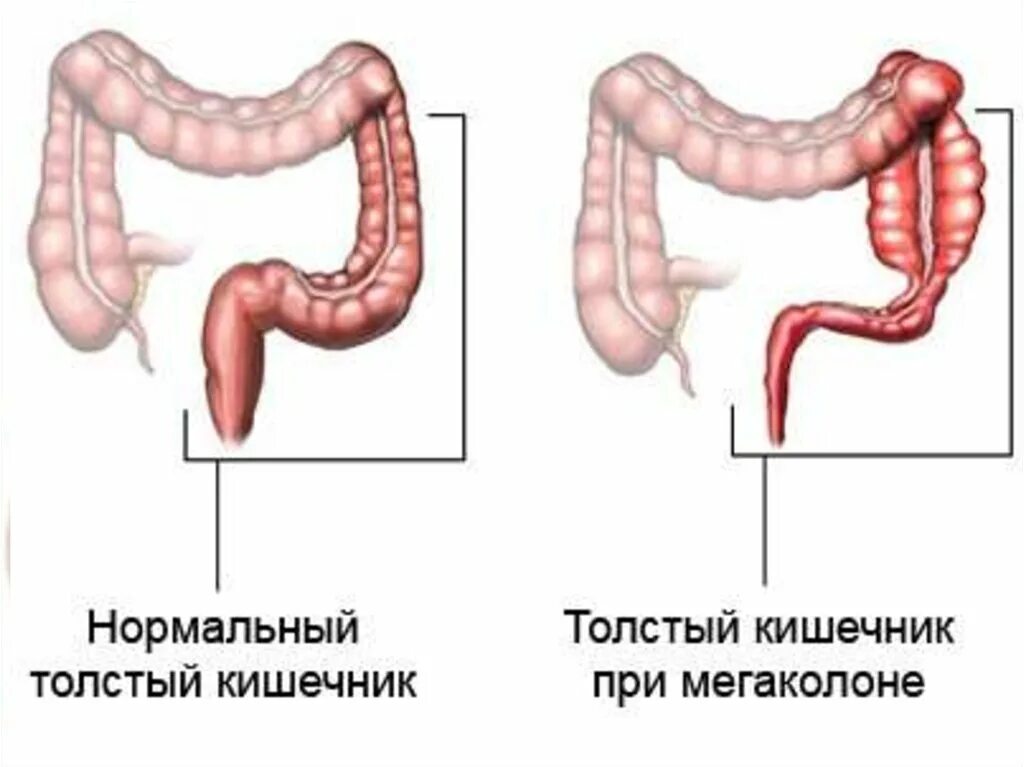 Удлинена сигмовидной. Толстая кишка болезнь Гиршпрунга. Расширение Толстого кишечника мегаколон у детей. Мегаколон болезнь Гиршпрунга. Кишечник при болезни Гиршпрунга.