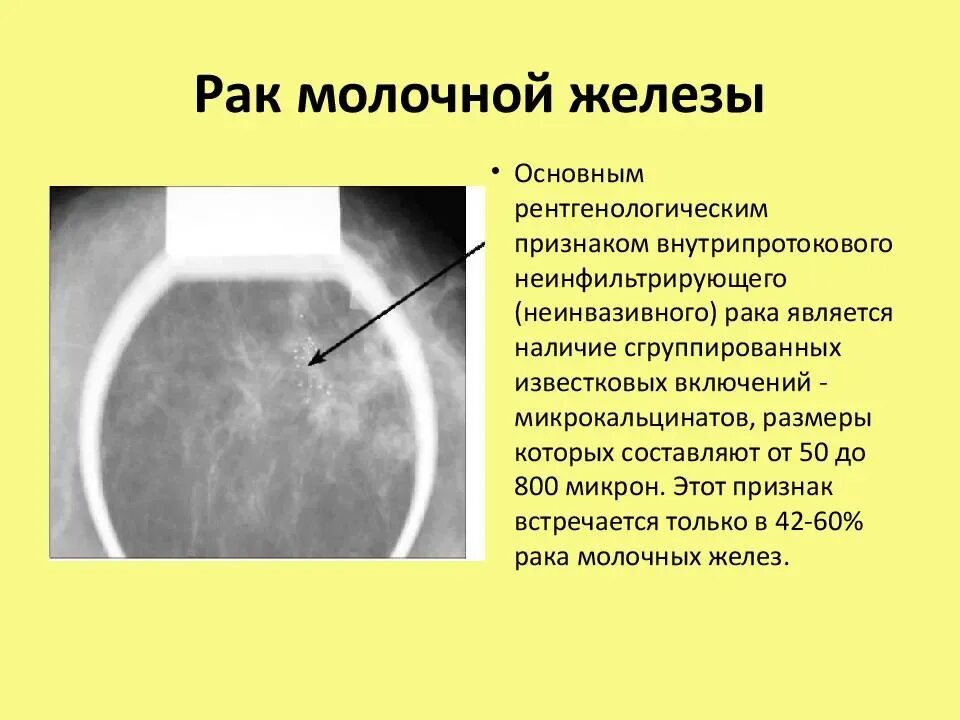 Твердая неподвижная. Опухоль молочной железы симптомы. Признаки ОАК молочной железы. Признаки опухоли в молочной железе. Онкология грудной железы симптомы.