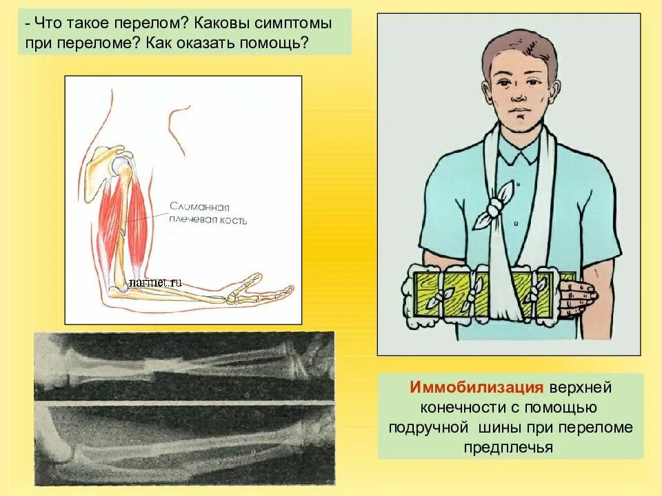Помощь при переломах конечностей
