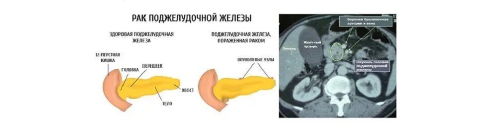 Лечение опухоли поджелудочной. Перешеек поджелудочной железы на кт. Опухоль крючковидного отростка поджелудочной железы кт. Опухоль головки поджелудочной железы 4 стадии. Опухоль поджелудочной железы на кт.