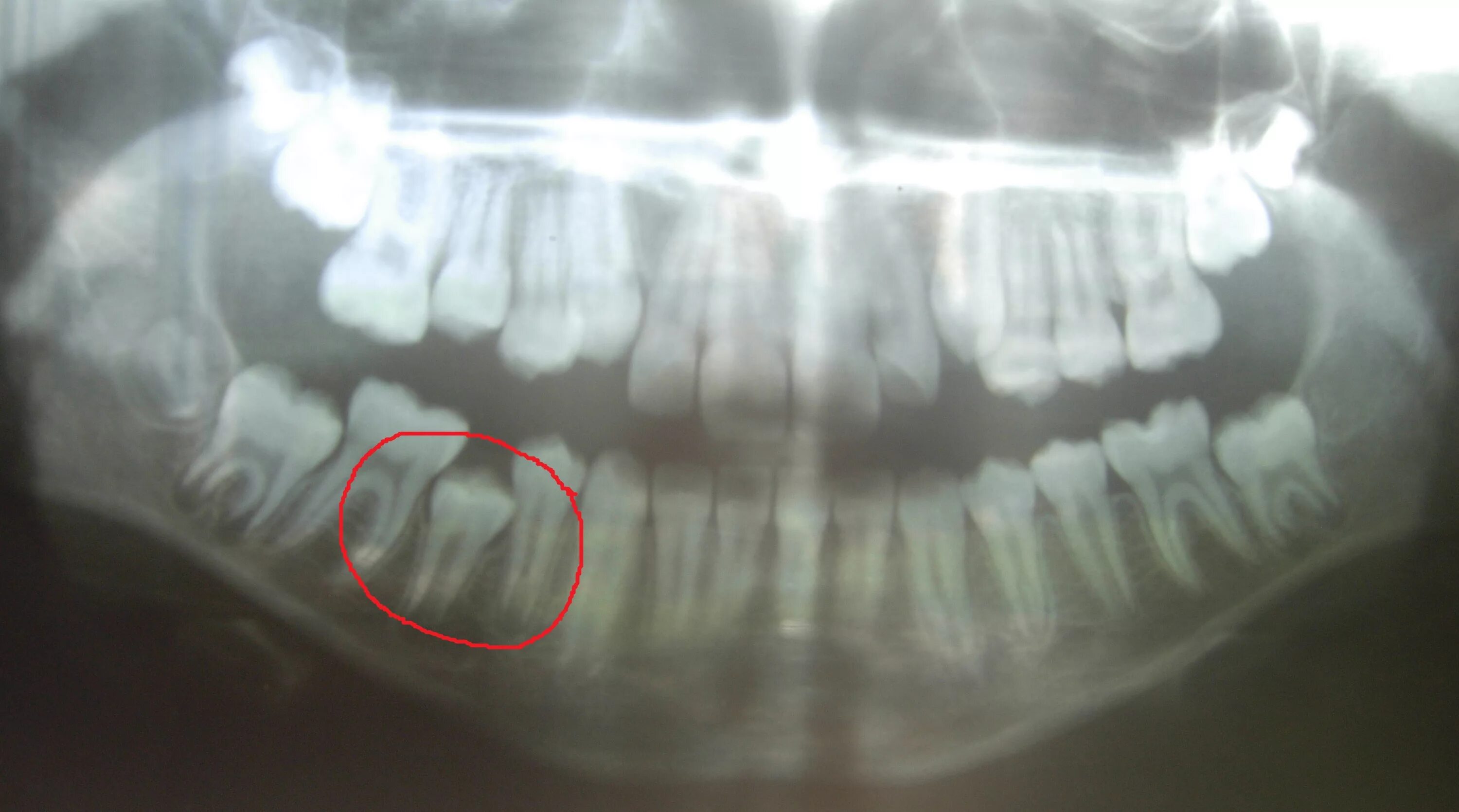 Снимок зубов видное. Ретинированный зуб мудрости рентген. Ортопантомограмма киста зуба. ОПТГ Зубочелюстная аномалия.