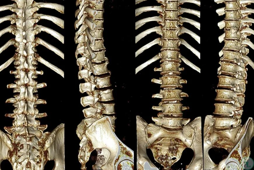 Компьютерная томография пояснично-крестцового отдела позвоночника. Снимок РКТ позвоночника. Кт грудного отдела позвоночника. РКТ грудного отдела позвоночника.
