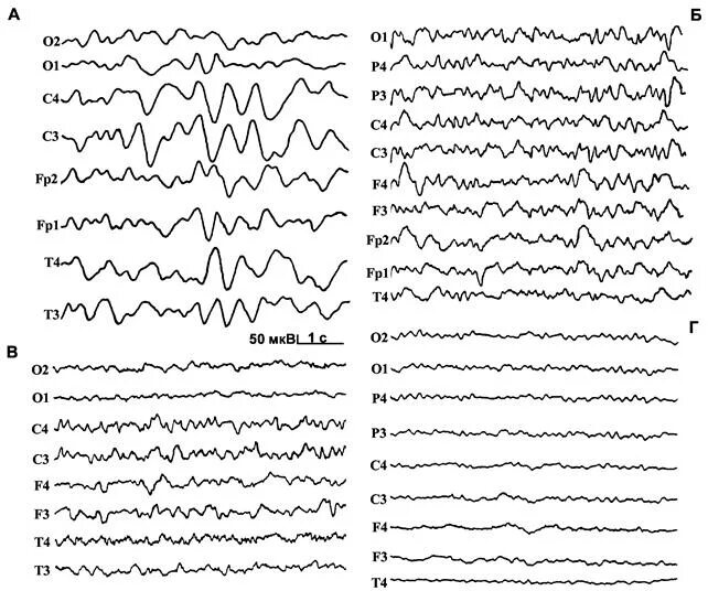 Межполушарная асимметрия на ЭЭГ норма. Схема ЭЭГ 10-20. Возрастные изменения на ЭЭГ У детей. ЭЭГ нормального головного мозга. Записаться на ээг