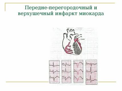 Передне перегородочная область на экг