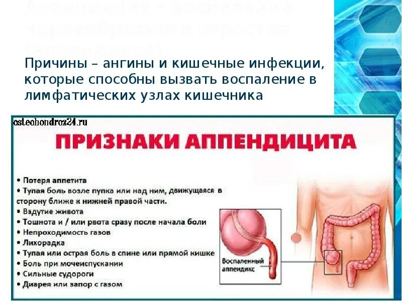 Может ли быть аппендицит с левой стороны. Симптомы при аппендиците. воспаление аппендицита признаки.