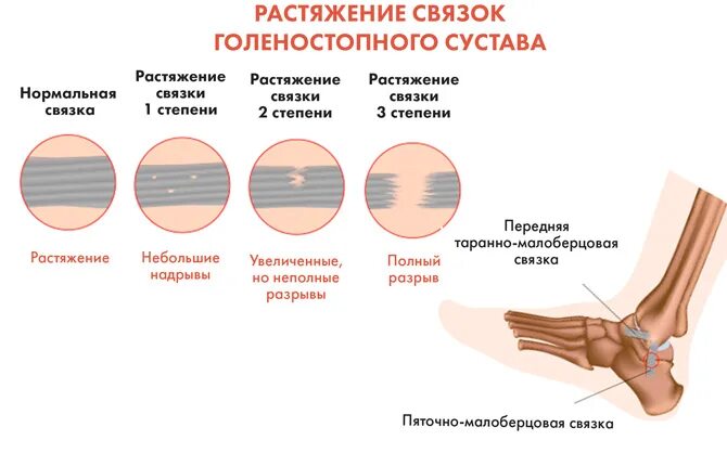 Разрыв и растяжение. Степени повреждения голеностопных связок. Травма голеностопного сустава растяжение связок. Повреждение связок 1 степени голеностопного. Разрыв связки третьей степени голеностопного сустава.