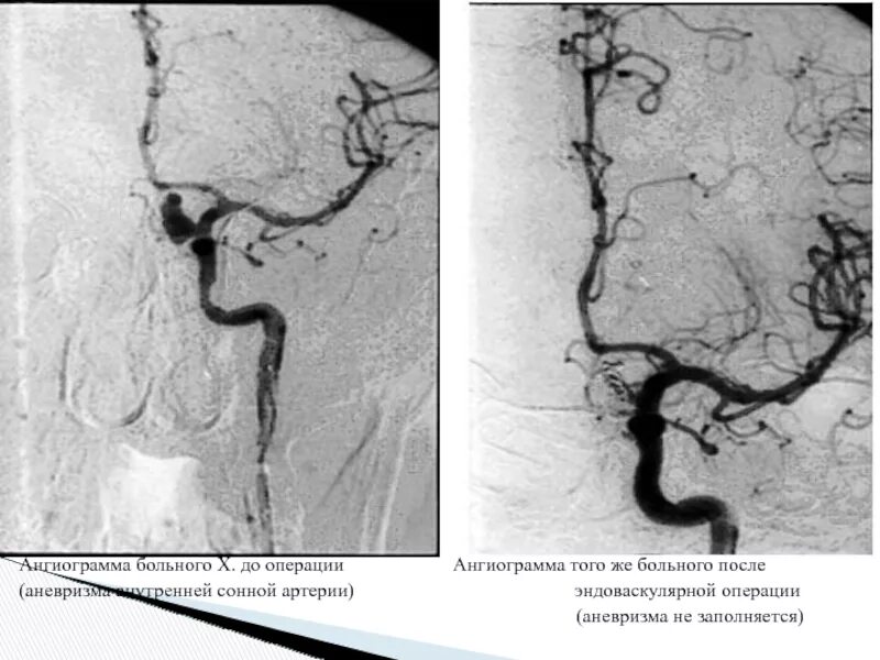 Аневризма сонной артерии что это. Мешотчатая аневризма ВСА. Кальцинированная аневризма ВСА. Фузиформная аневризма внутренней сонной артерии. Фузиформное расширение внутренней сонной артерии.