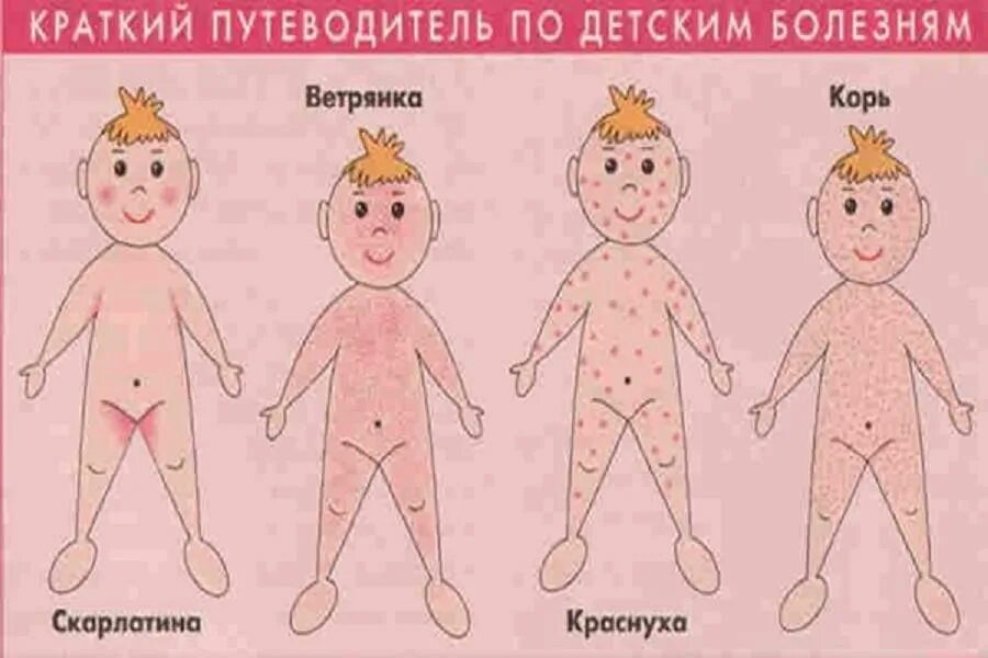 Как распознать корь у ребенка. Сыпь при корь краснуха. ветрянка скарлатина корь краснуха сыпь. краснуха корь скарлатина сыпь. краснуха сыпь краснуха у детей.