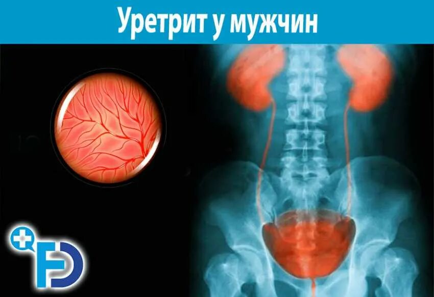 Инфекция уретры. Мочеиспускательный канал болезни. Врожденный дивертикул уретры. Инфекции уретры у женщин. Проявления уретрита у мужчин.