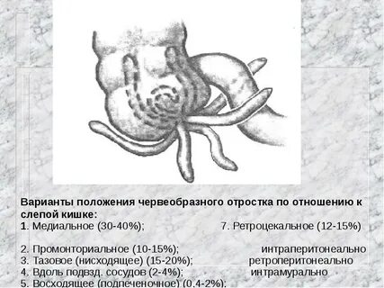 Виды аппендикса