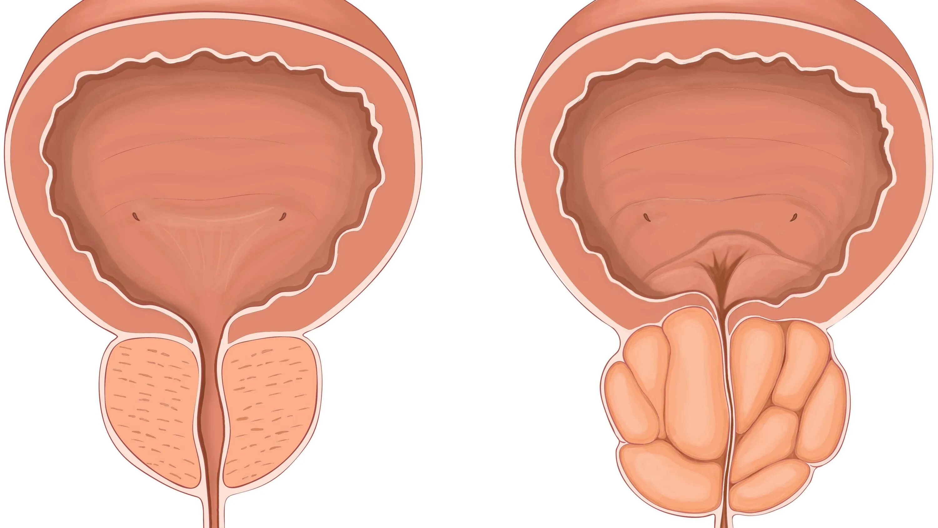 Аденома предстательной железы. Простатит предстательной железы. Аденома предстательной железы (аденома простаты). Нарезка простата