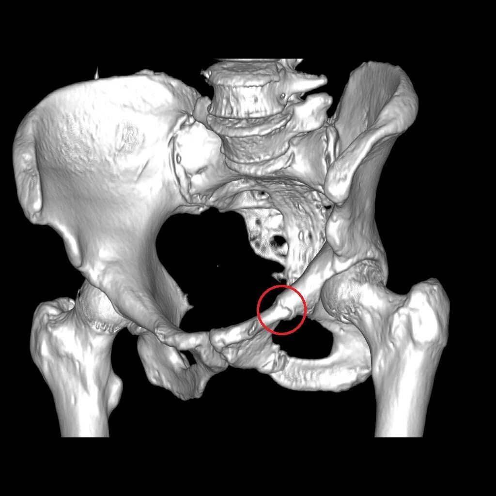 Кт подвздошной кости. Кт костей таза перелом лонной кости. Лобковая кость перелом. Перелом лонной кости кт. Анатомия костей таза на кт.