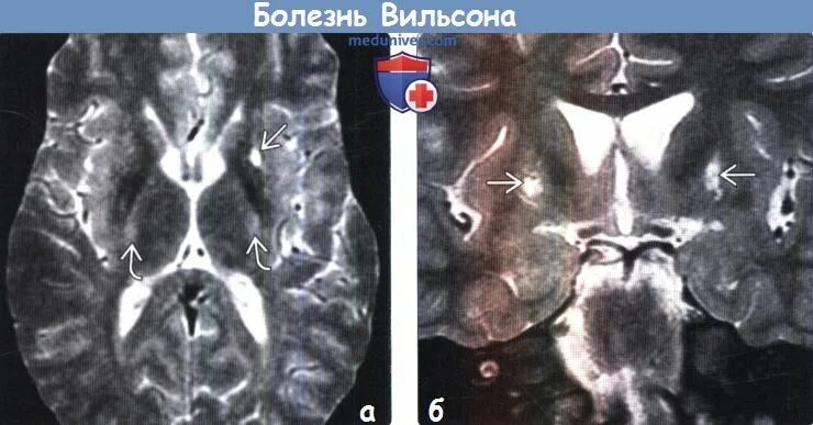 Дегенерация головного. Болезнь Вильсона Коновалова мрт головного мозга. Вильсона Коновалова мрт. Гепатолентикулярная дегенерация мрт. Болезнь Коновалова Вильсона кт головного мозга.