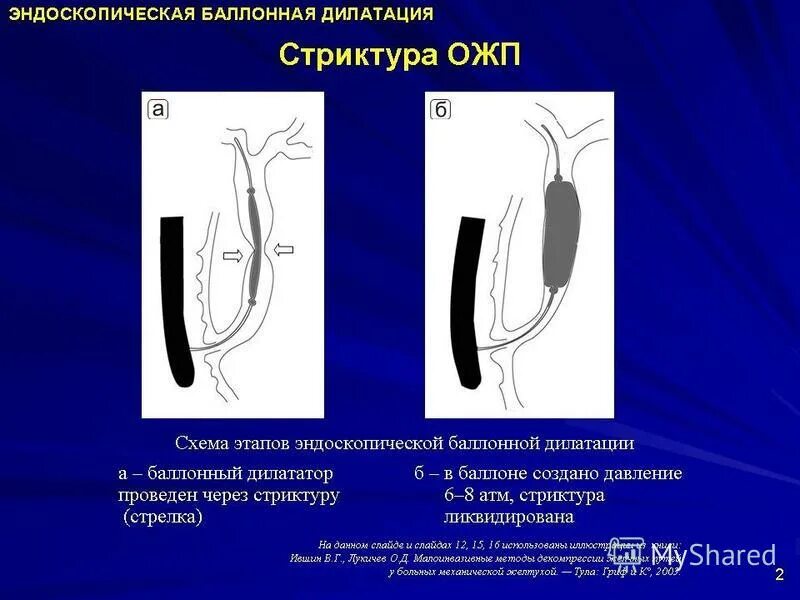 Стент желчного протока