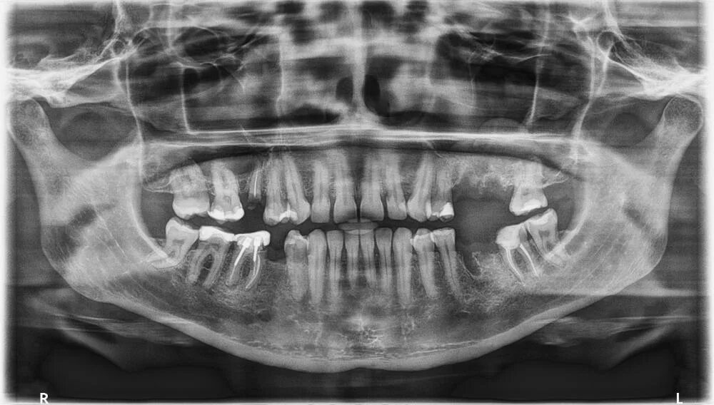 Снимок зубов видное. ОПТГ зубных рядов Пикассо. Ортопантомограмма пародонтит. Рентген зубов панорамный снимок Пикассо.