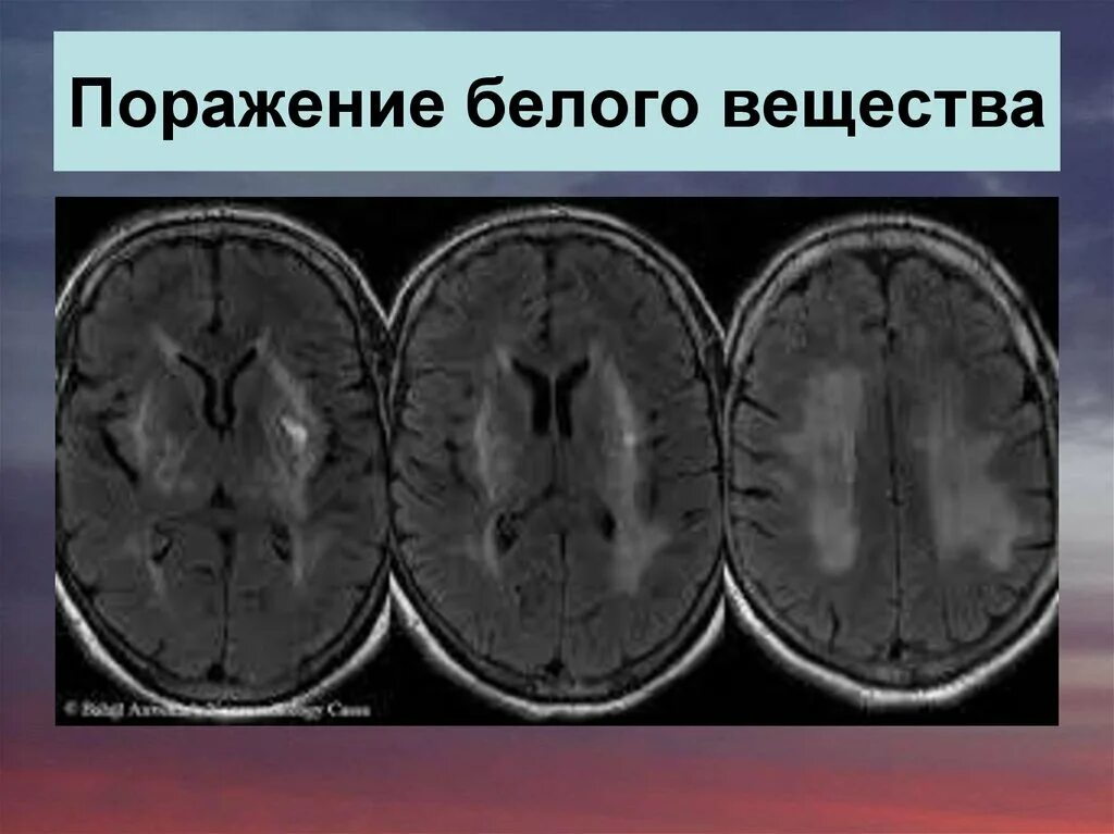 Вазогенный очаг больших полушарий. Токсическое поражение головного мозга кт. Поражение белого вещества головного мозга. Очаговое поражение вещества головного мозга. Поражение белого вещества головного мозга мрт.