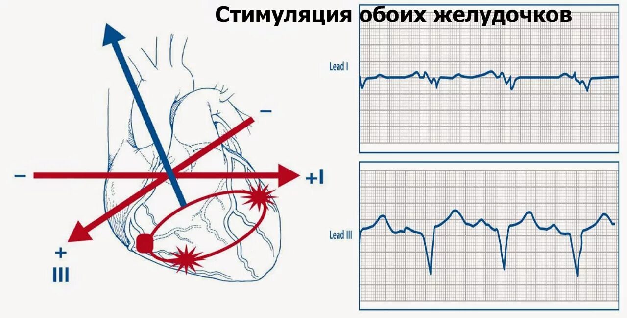 стимуляция желудочков. р синхронизированная стимуляция на экг. р синхронизированная стимуляция желудочков на экг. гипосенсинг экс. стимуляция желудочков.