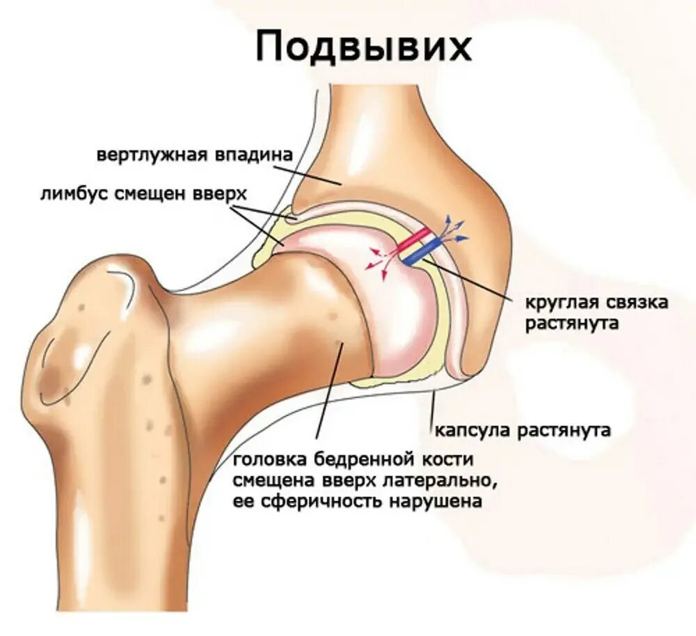Растяжение тазобедренного сустава мкб. Суставная капсула тазобедренного сустава. подвывих головки левой бедренной кости. дисплазия головки бедренной кости. дисплазия плечевого сустава.