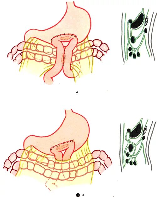 Передний желудочно кишечный анастомоз. Задняя гастроэнтеростомия по Гаккеру петерсону. Гастроэнтеростомия топографическая анатомия. Задний желудочно кишечный анастомоз. Операция желудка кишечника
