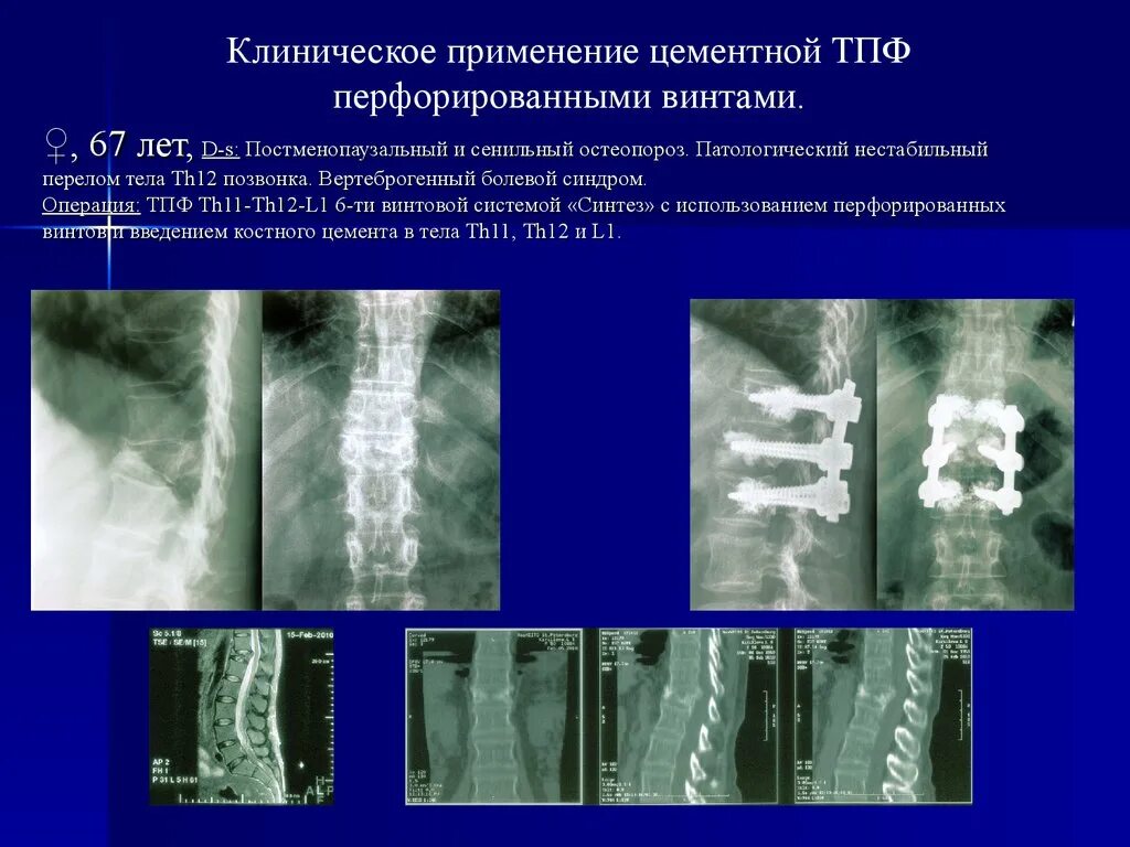 Компрессионный перелом позвоночника th12 l3. Компрессионный перелом l1 th12. Патологические переломы позвонков при остеопорозе. Патологический перелом тела th12. Компрессионный перелом тела 1 1