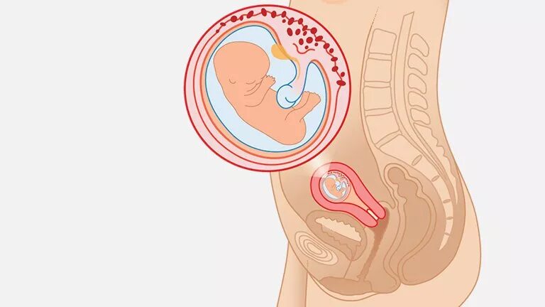 Was 10 in weeks. 10 weeks pregnant. abdominal pregnancy x брюшная беременность.